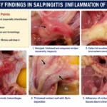 Necropsy Findings in Salpingitis